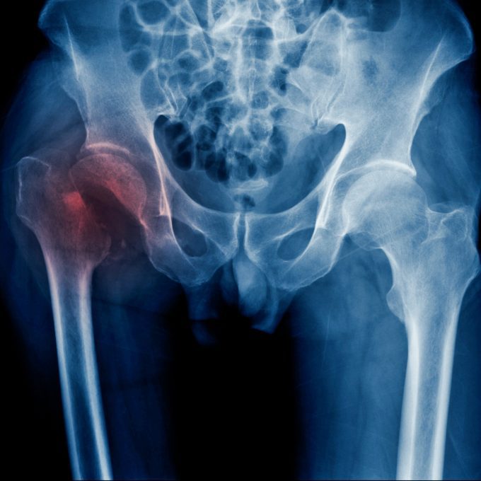 Orthopaedic and Skeletal Injuries