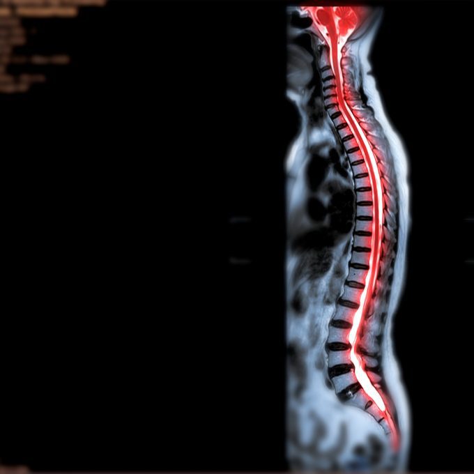 Spinal Surgery and Paralysis Claims